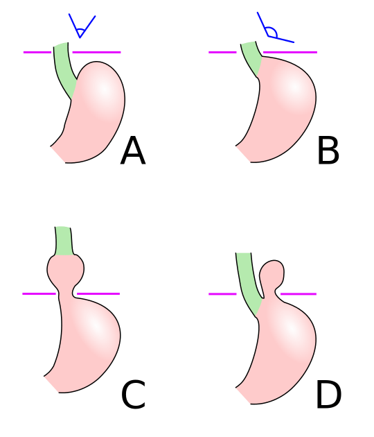 Schematic diagram of different types of hiatal hernia