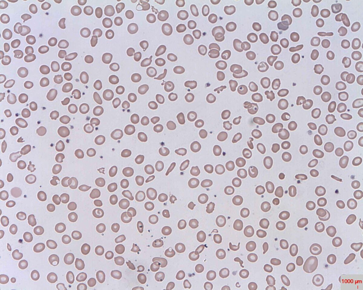 Schistocytes