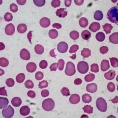 Schistocytes as diagnostic of DIC