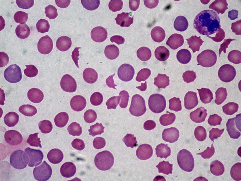 Schistocytes as diagnostic of dic