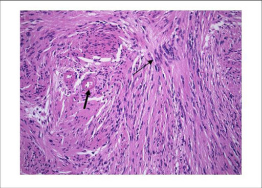 Schwannoma histology