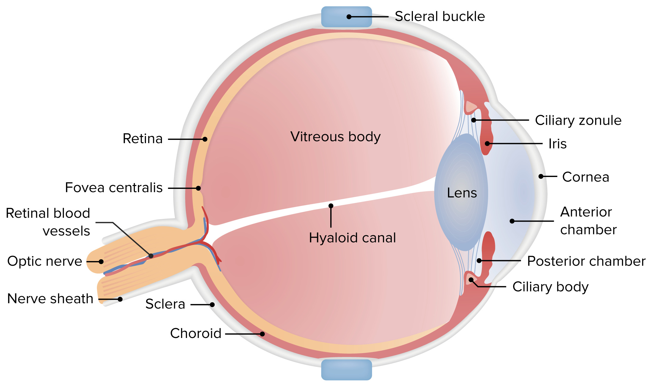 retinal hemorrhage diagram