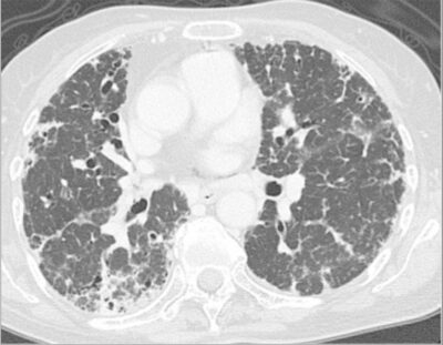 Scleroderma | Concise Medical Knowledge