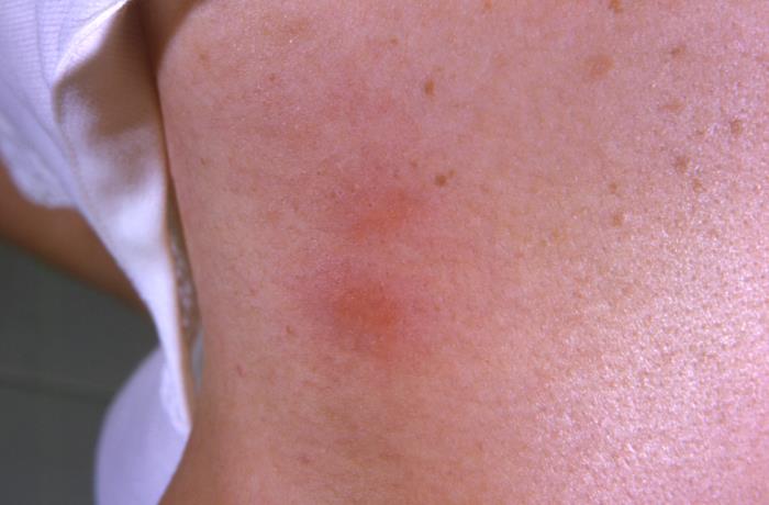 Scleroderma sp. Wasp sting on shoulder