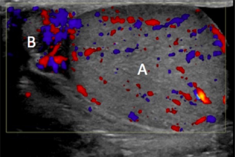 Ultrassonografia doppler escrotal