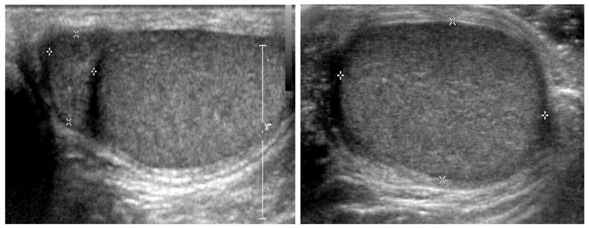 Scrotal ultrasonograms showing the testicle as a homogeneous echotexture with no focal lesions or surrounding fluid and the epididymis