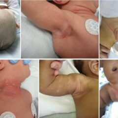 Seborrheic dermatitis in newborns