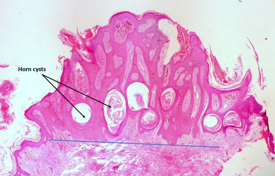 frictional keratosis histology