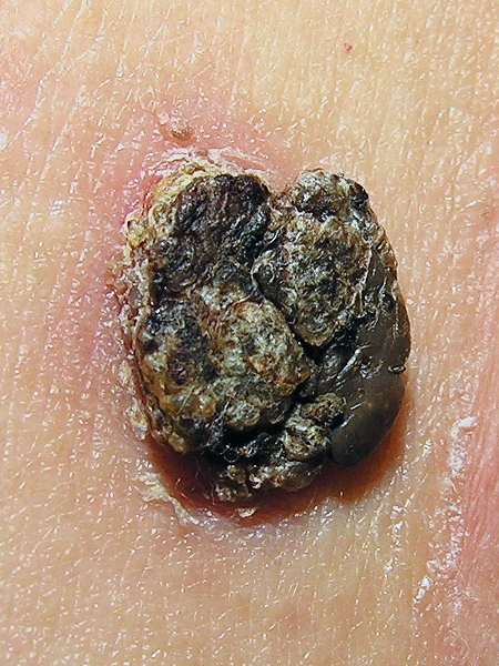 inflamed seborrheic keratosis