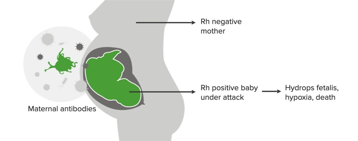 Second, dangerous pregnancy with rhesus incompatibility