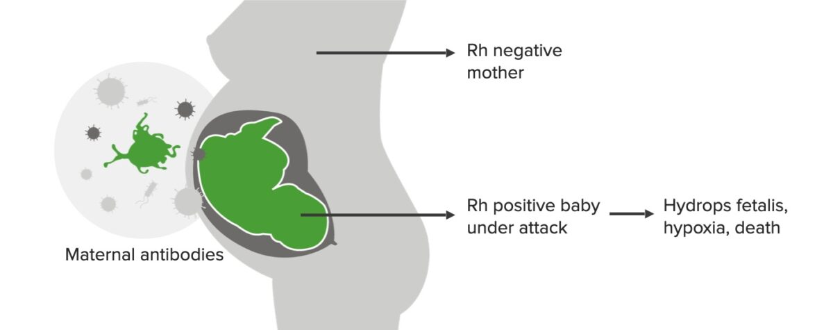 Em segundo lugar, gravidez perigosa com incompatibilidade rhesus