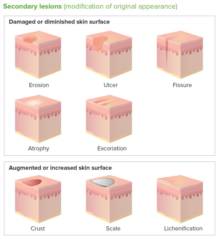 Secondary Skin Lesions Concise Medical Knowledge