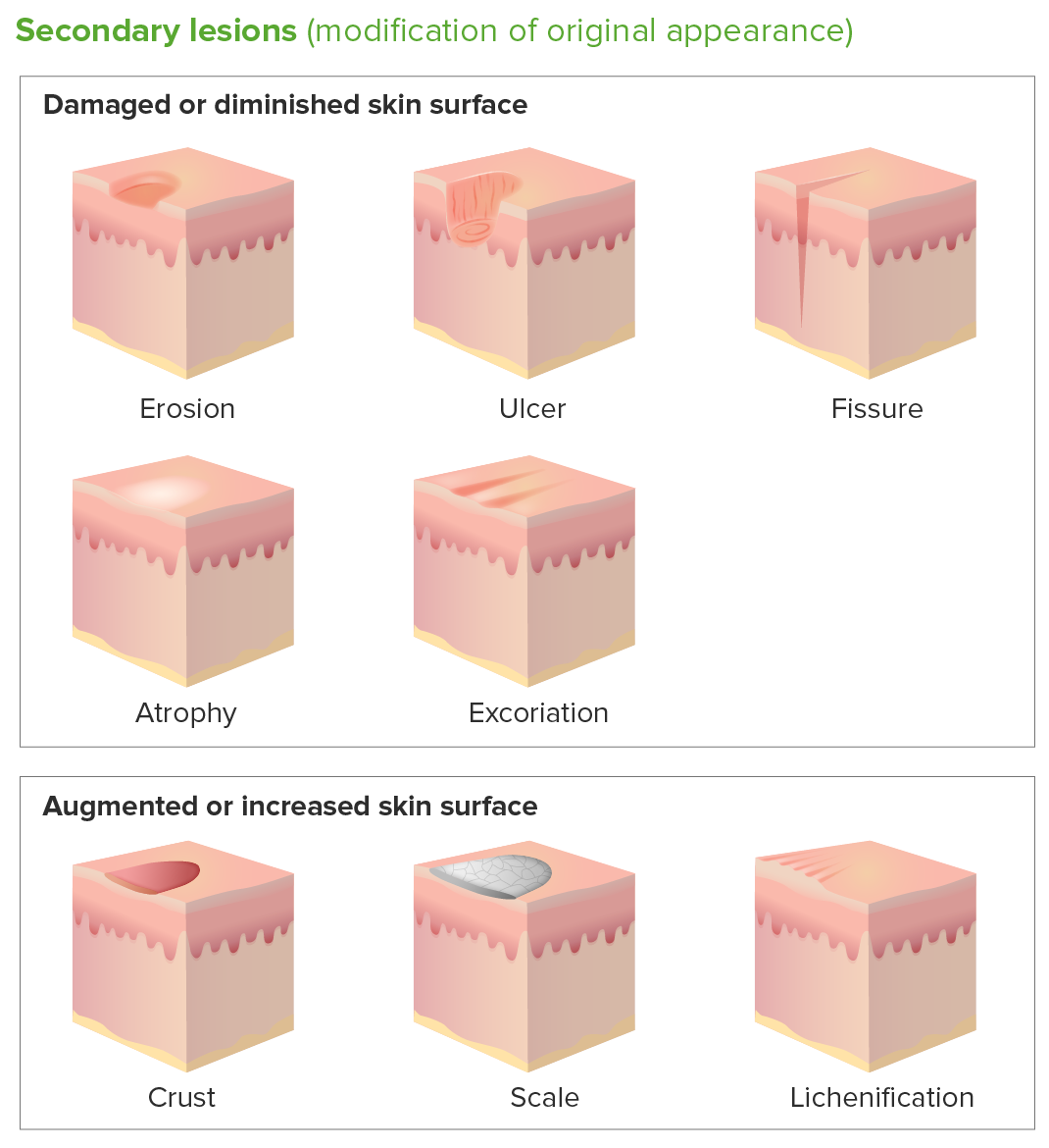 erosion skin lesion