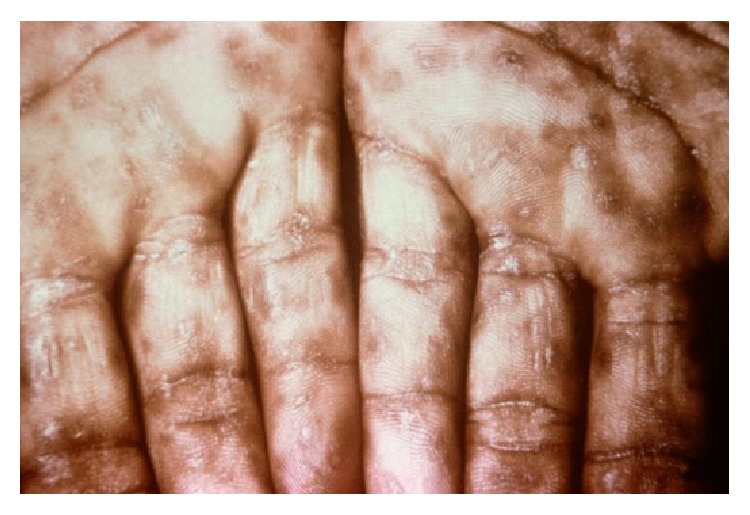 Secondary syphilis lesions on palms