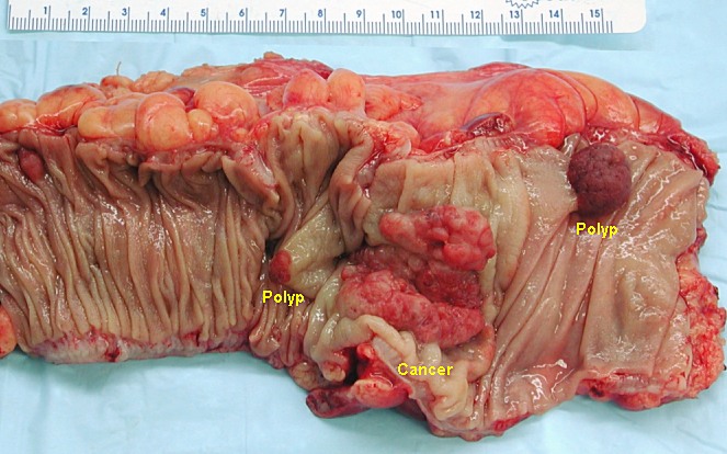 Segmento de colon resecado en estado no fijado que contiene un carcinoma colorrectal invasivo y dos pólipos adenomatosos
