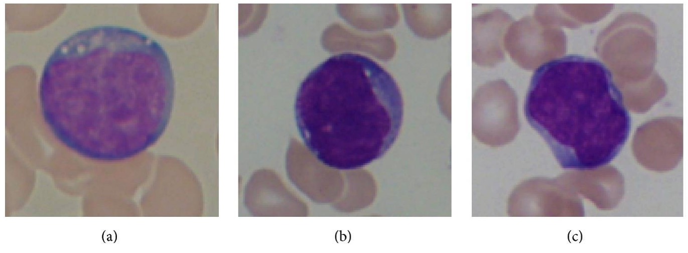 Segmentation of white blood cell from acute lymphoblastic leukemia