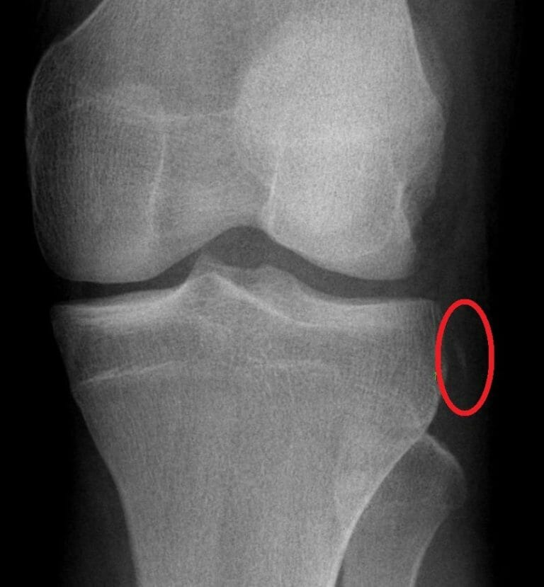 Lesiones De Los Ligamentos De La Rodilla Concise Medical Knowledge