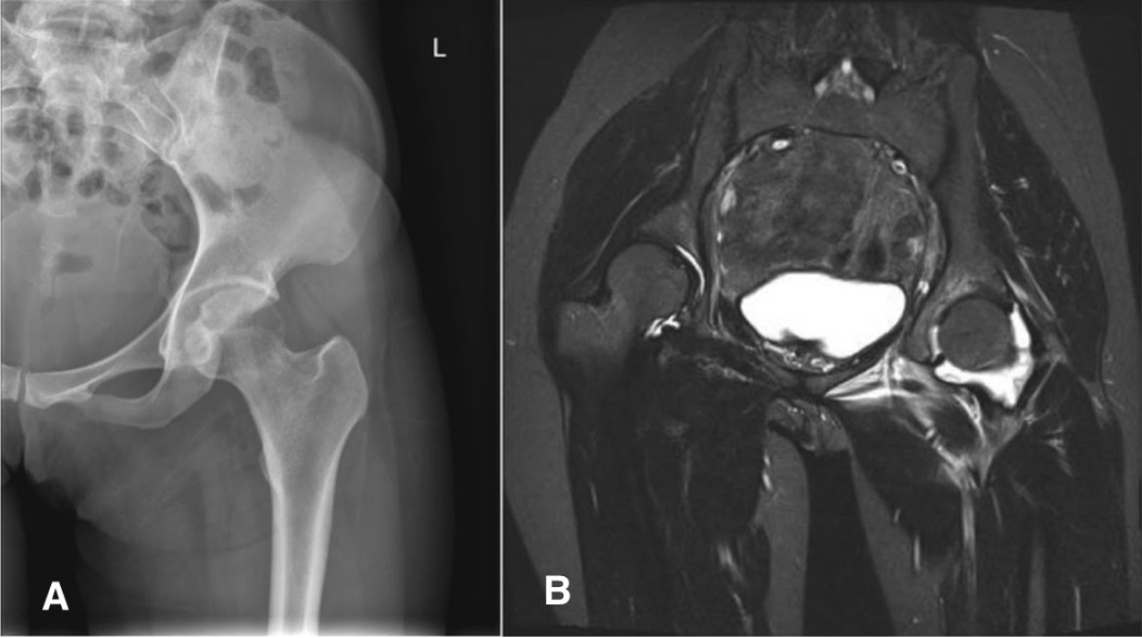 Septic arthritis caused by brucella melitensis.