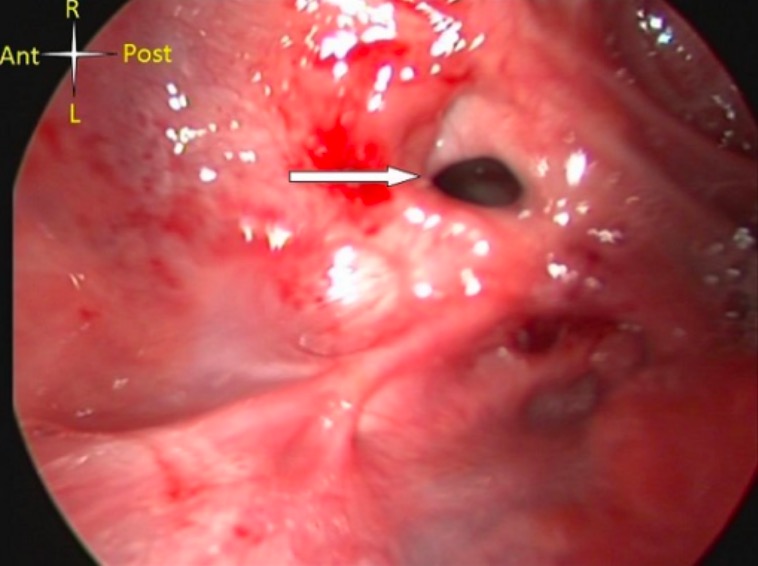 Severe caustic injury of the pharynx