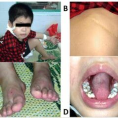 Severe congenital neutropenia lesions