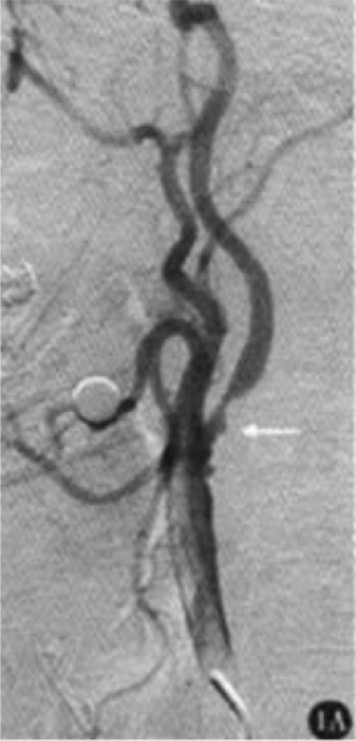 Severe stenosis of left internal carotid artery