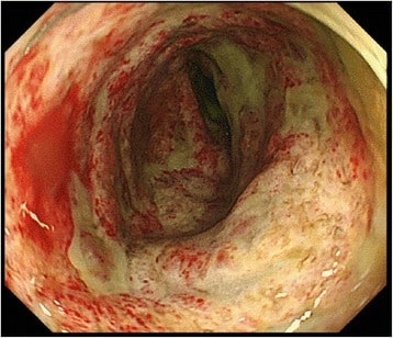 Severe ulcer and pseudomembrane at the descending colon