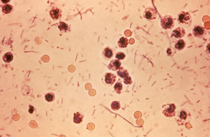 Shigellosis