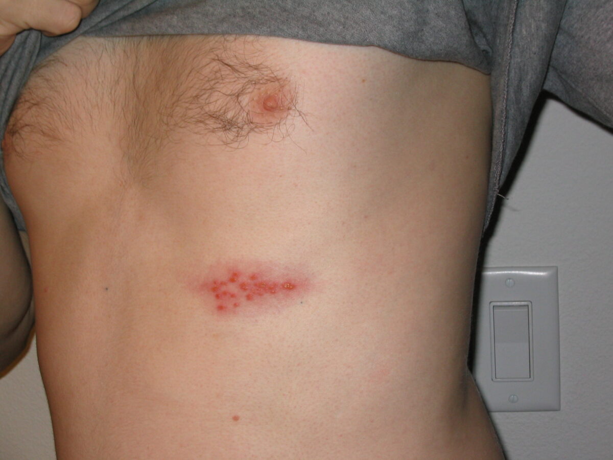 Shingles outbreak on the chest herpes zoster