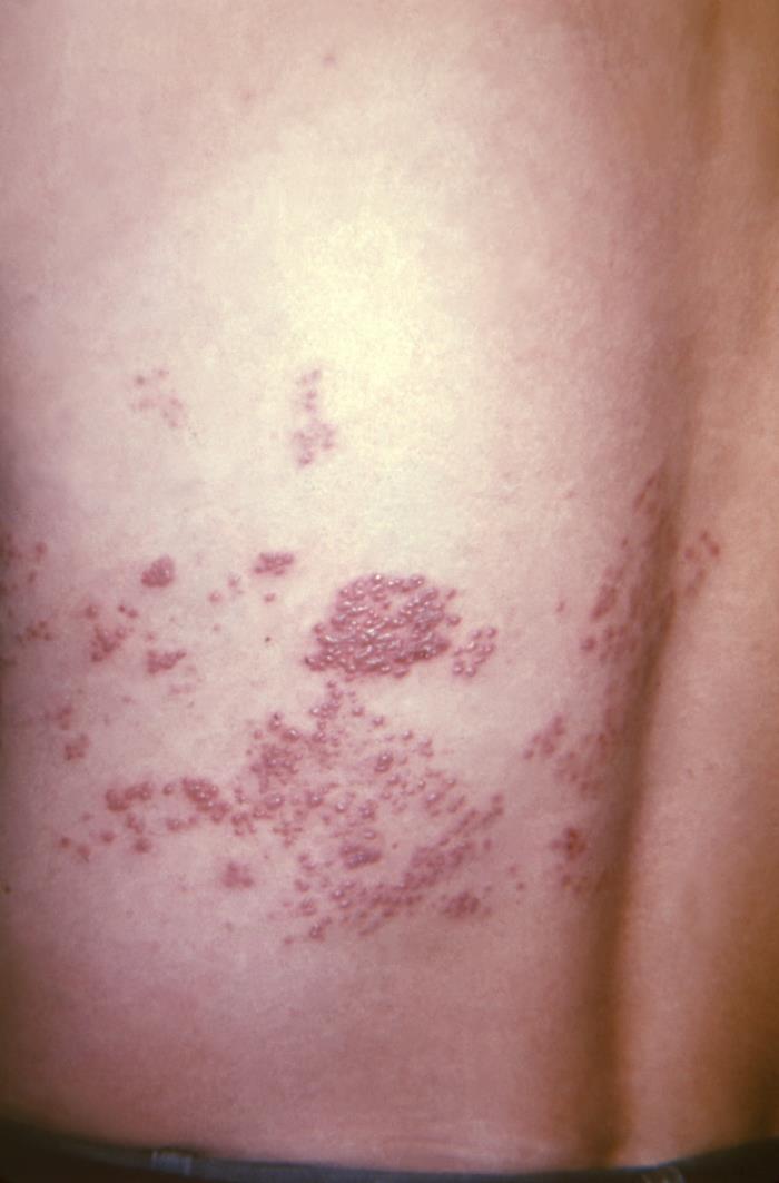Herpes Zoster Zona Concise Medical Knowledge
