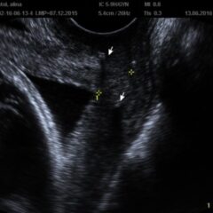 Shortened cervix on ultrasound