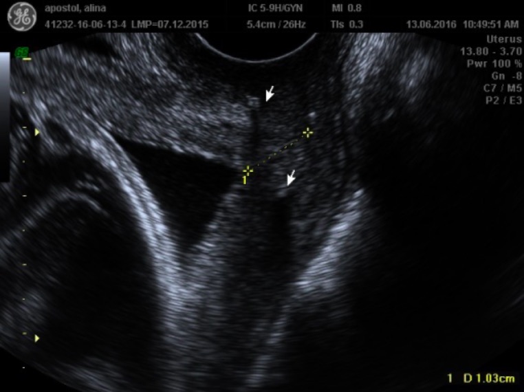 Cérvix acortado en el ultrasonido