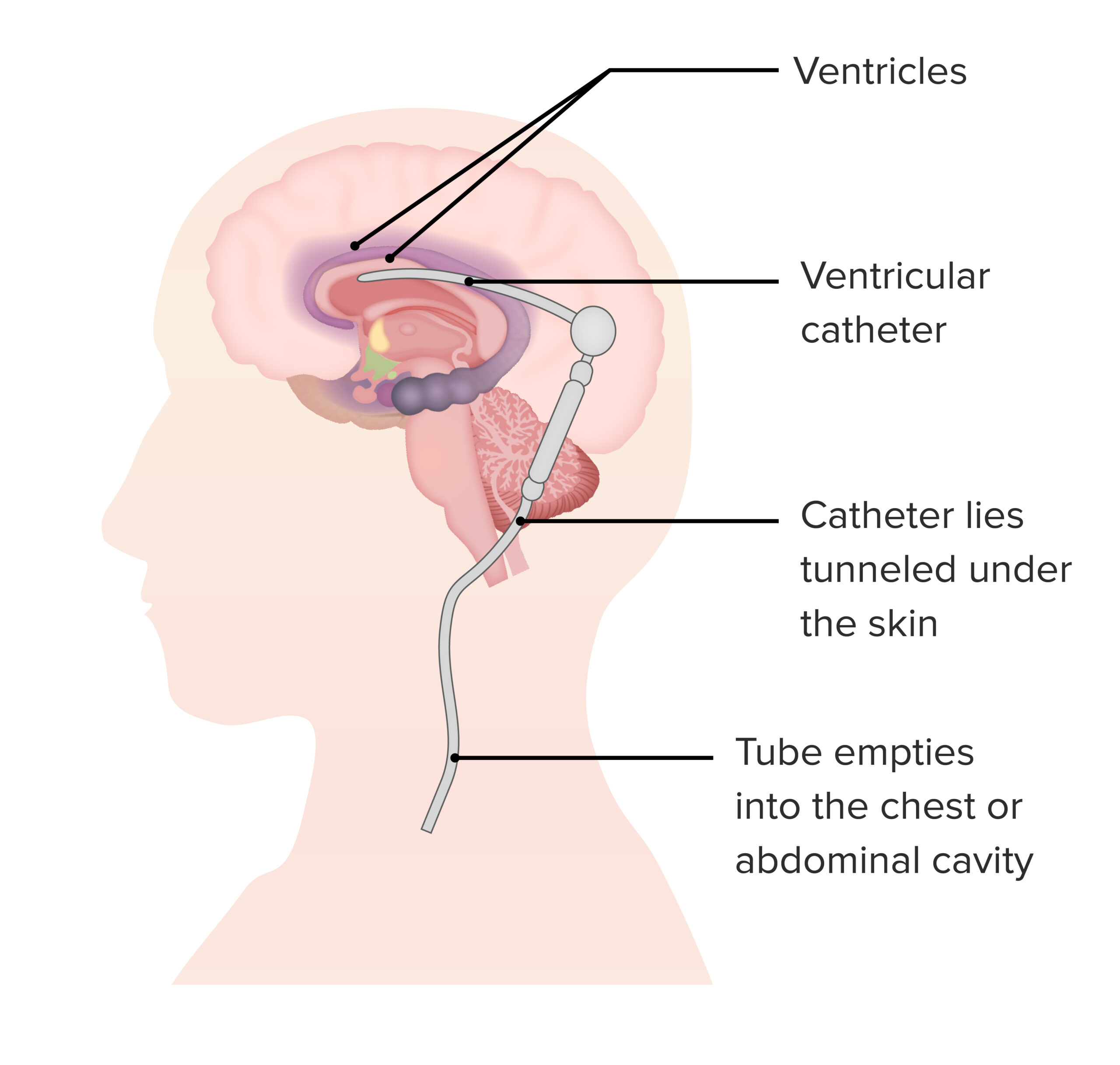 Niemann-Pick disease type C: Video & Anatomy