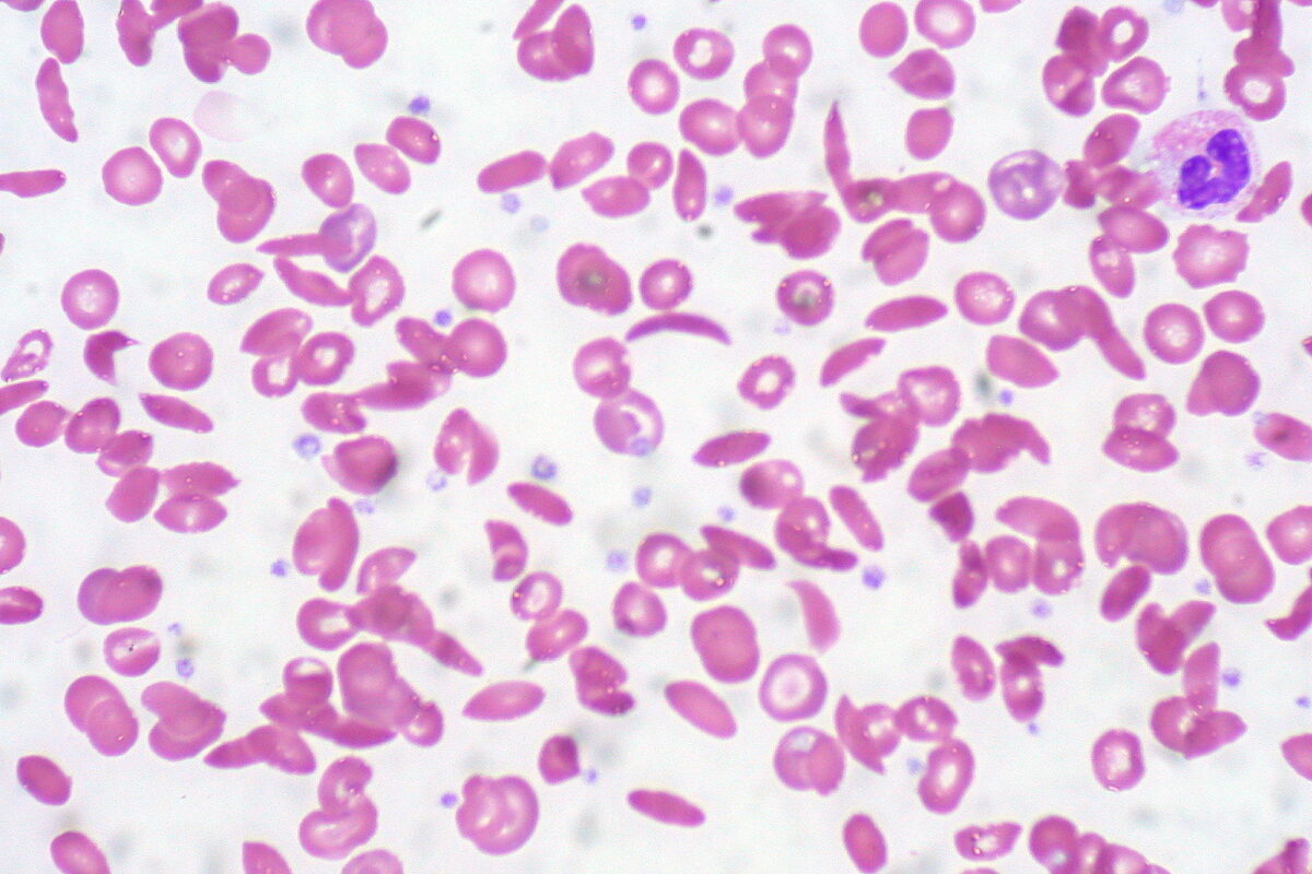 Anemia falciforme - esfregaço de sangue periférico