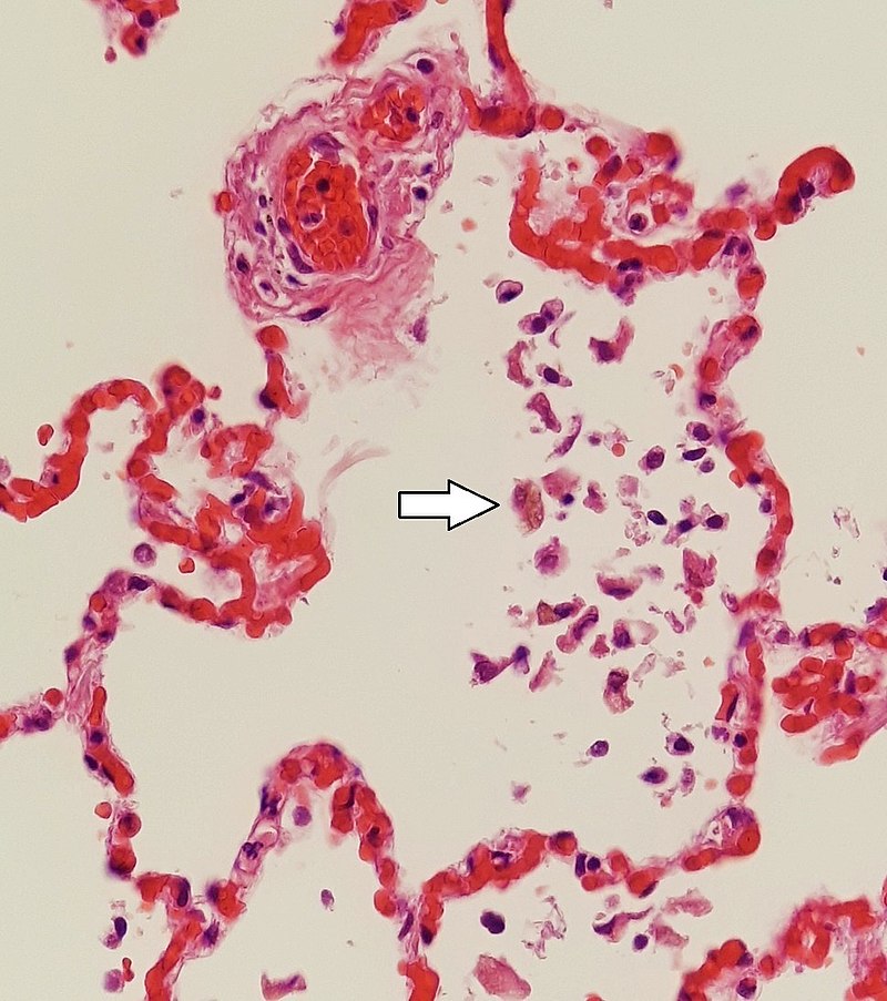 Siderophages and pulmonary congestion