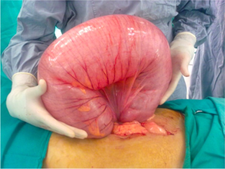 Sigmoid volvulus during surgery