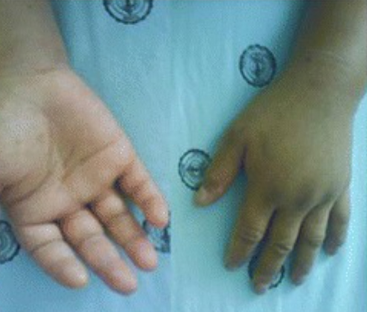 Significant swelling of the hands due to angioedema