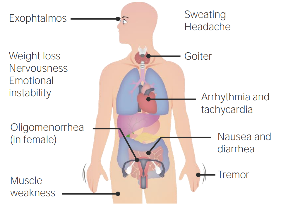 Signs and symptoms of hyperthyroidism Signs and symptoms of hyperthyroidism