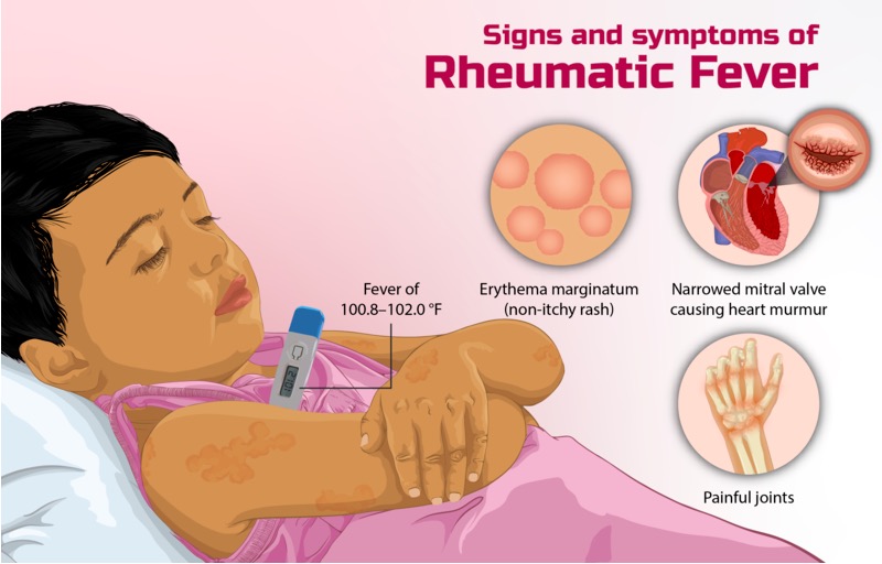 rheumatic-fever-concise-medical-knowledge