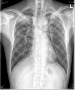 Chest x-ray silicosis