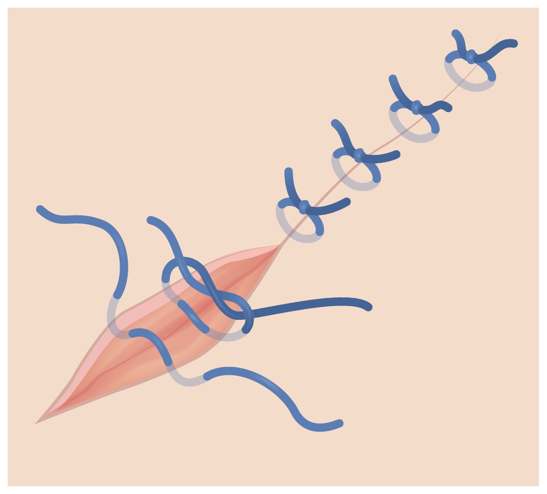 Step-by-Step Guide to Stitches (Placing & Removing Sutures)