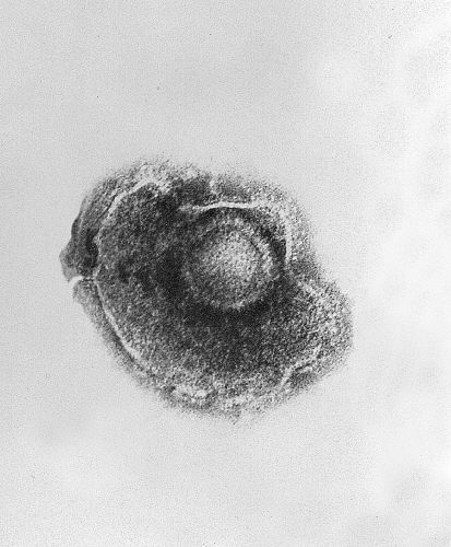 Um único vírus varicela-zoster herpes zoster