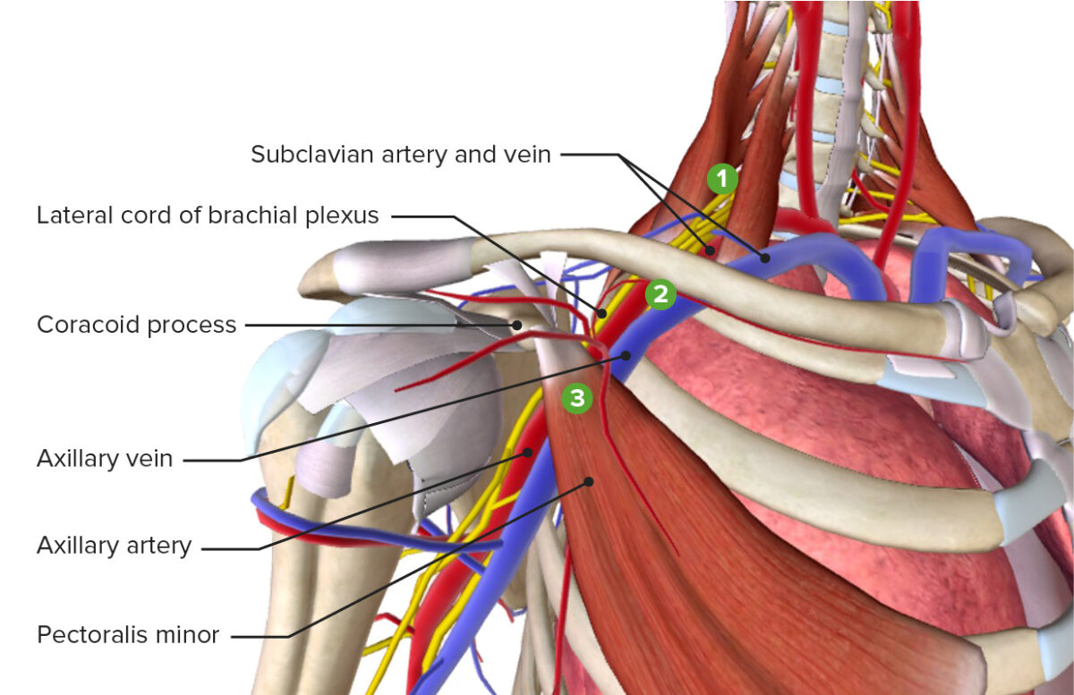 Thoracic Outlet Syndrome Concise Medical Knowledge Thoracic Outlet Syndrome Concise Medical Knowledge