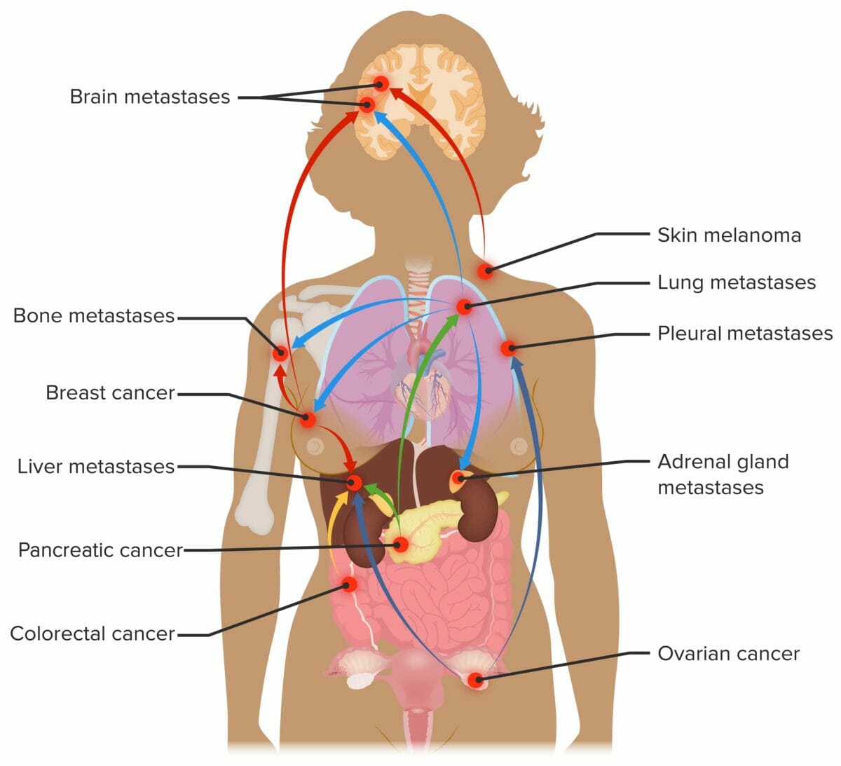 Sites of metastasis