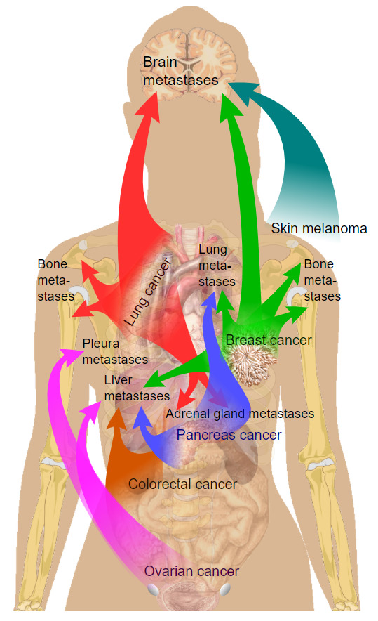 Sites of metastasis