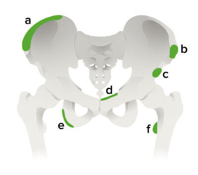 Sites of pelvic apophyseal avulsion fractures
