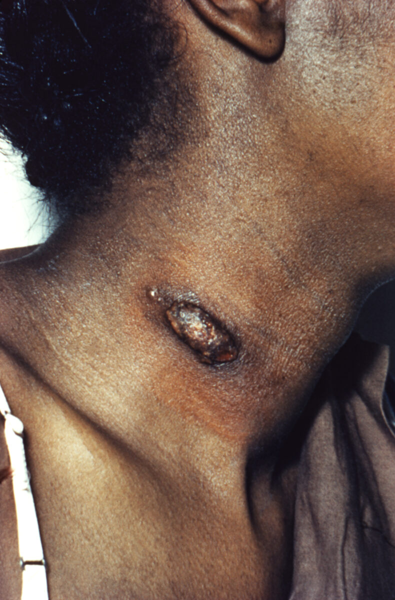 Skin lesions caused by coccidioides infection