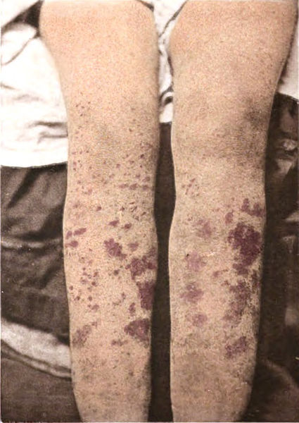Skin manifestation of dic - purpura