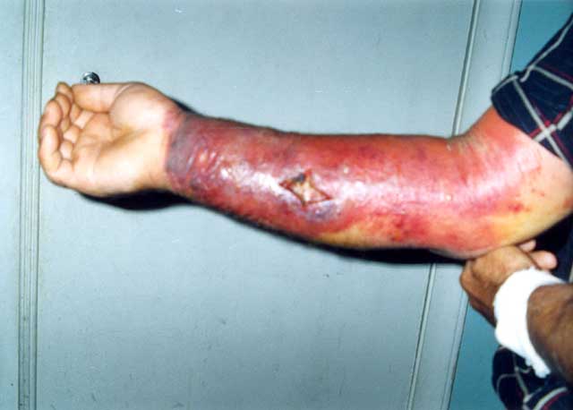 Skin reaction to anthrax