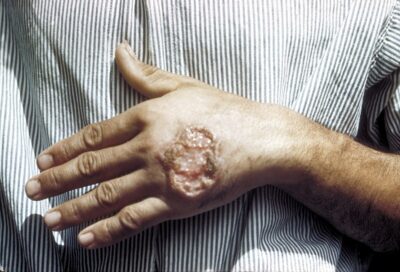 Skin ulcer due to leishmaniasis