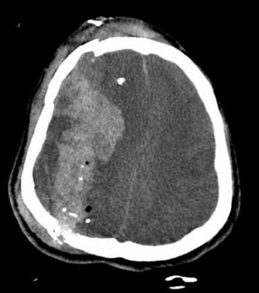 forehead skull fracture